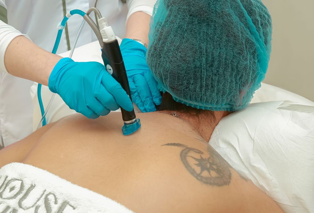 Laser handpiece being used near a tattoo on a client's upper back